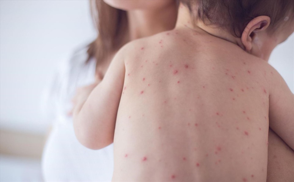 Các biện pháp phòng, chống bệnh đậu mùa khỉ