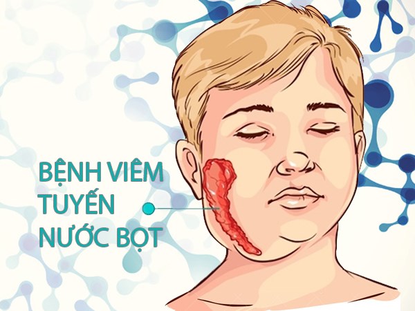 Các biến chứng nguy hiểm thường gặp, chúng ta cần làm gì để phòng và điều trị bệnh Quai bị