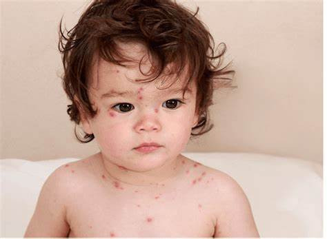 Bài tuyên truyền về cách phòng, chống bệnh Thủy đậu