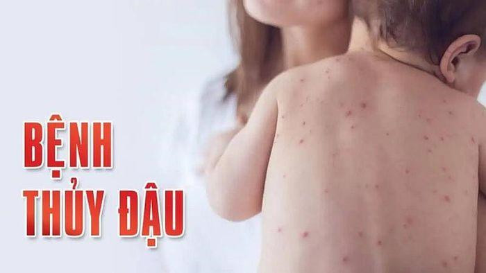 Bệnh thủy đậu tăng cao bất thường, người dân cần làm gì để phòng chống?