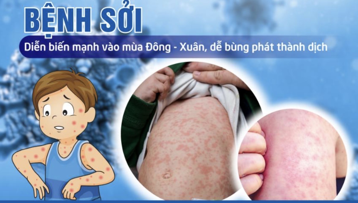 Cách nhận biết và các biện pháp phòng, chống bệnh Sởi và Rubella ở trẻ nhỏ